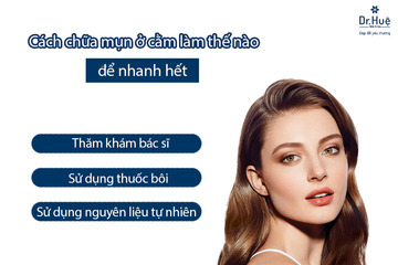 Cách chữa mụn ở cằm làm thế nào để nhanh hết